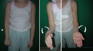 Congenital right radioulnar synostosis: significant limitation of supination. Patient subsequently underwent surgery.