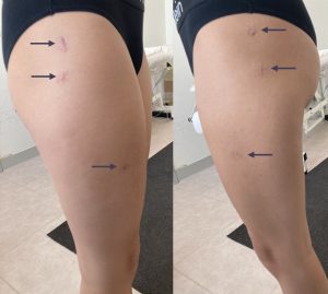 Intervento mini-invasivo per grave antiversione delle anche: cicatrici millimetriche