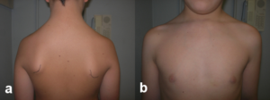Scapola alta sinistra in forma lieve