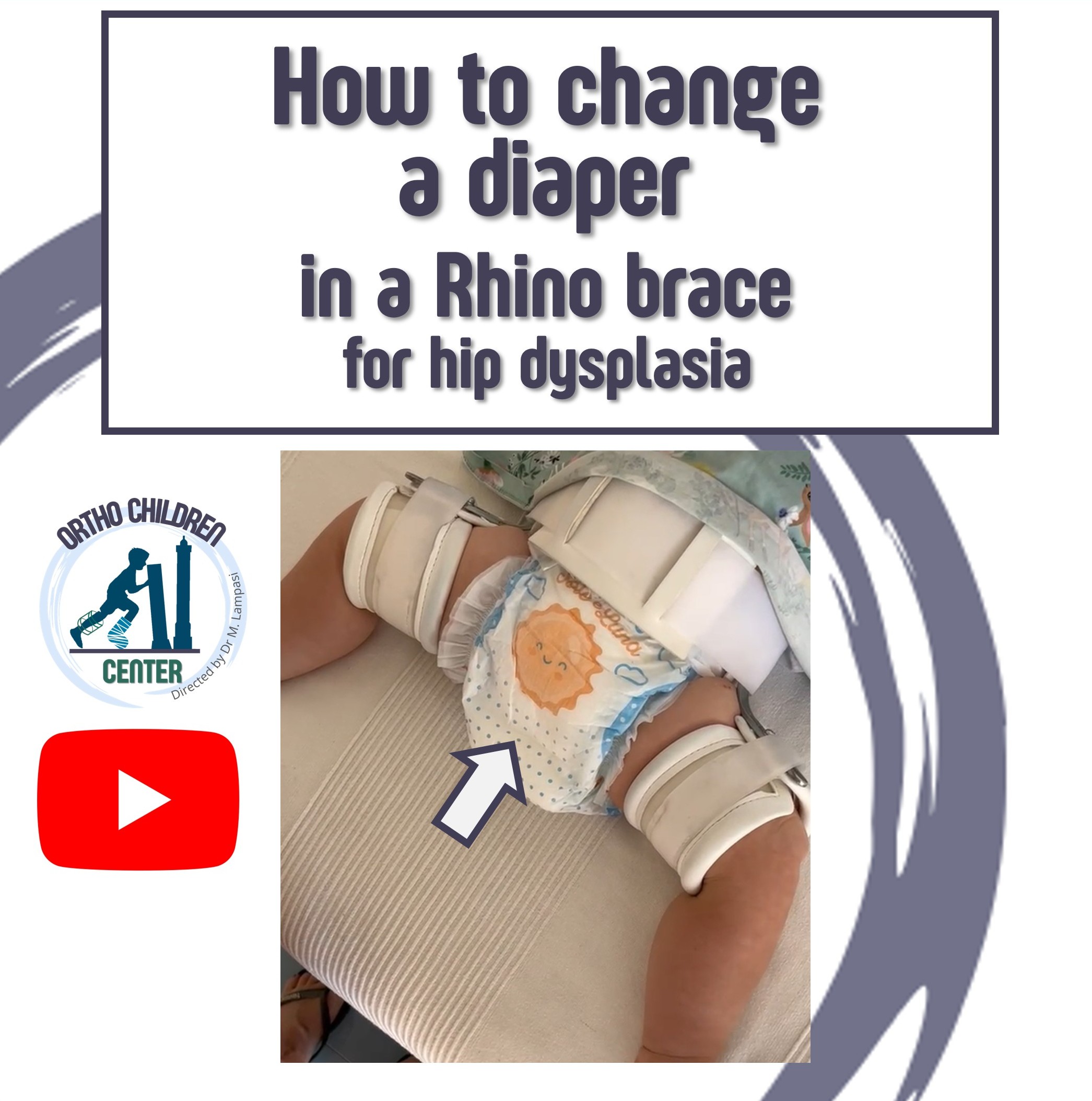 New tutorial: How to change a diaper in a Rhino brace for hip dysplasia