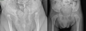 Bilateral hip dislocation in arthrogryposis (a); 2-year follow-up (b)