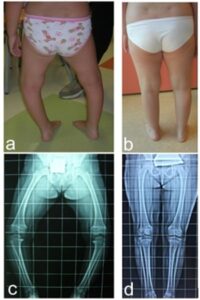 Sindrome genetica in via di definizione, varismo bilaterale con intratorazione trattato a 4 aa con osteotomia tibiale. Quadro clinico e radiografico pre (a, c) e post trattamento (b, d)