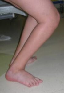 Overcorrection following bilateral Achilles tendon lengthening (crouch)