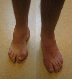 Patient with bilateral pes cavus varus and spinal dysraphism. Awaiting surgery on the right foot, he has already undergone correction of the left foot.
