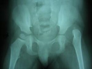 Lussazione anca sinistra in spina bifida (mielomeningocele)