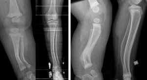 X-ray of posteromedial bowing of the tibia before and after remodeling in AP (a,b) and lateral (c,d) views.