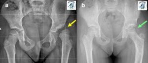Lussazione congenita dell’anca: ricostruzione (osteotomia femorale, tettoplastica, capsulorrafia)
