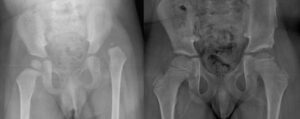 Left hip dislocation in arthrogryposis (a) and 5-year follow-up after open reduction and pelvic osteotomy (b)