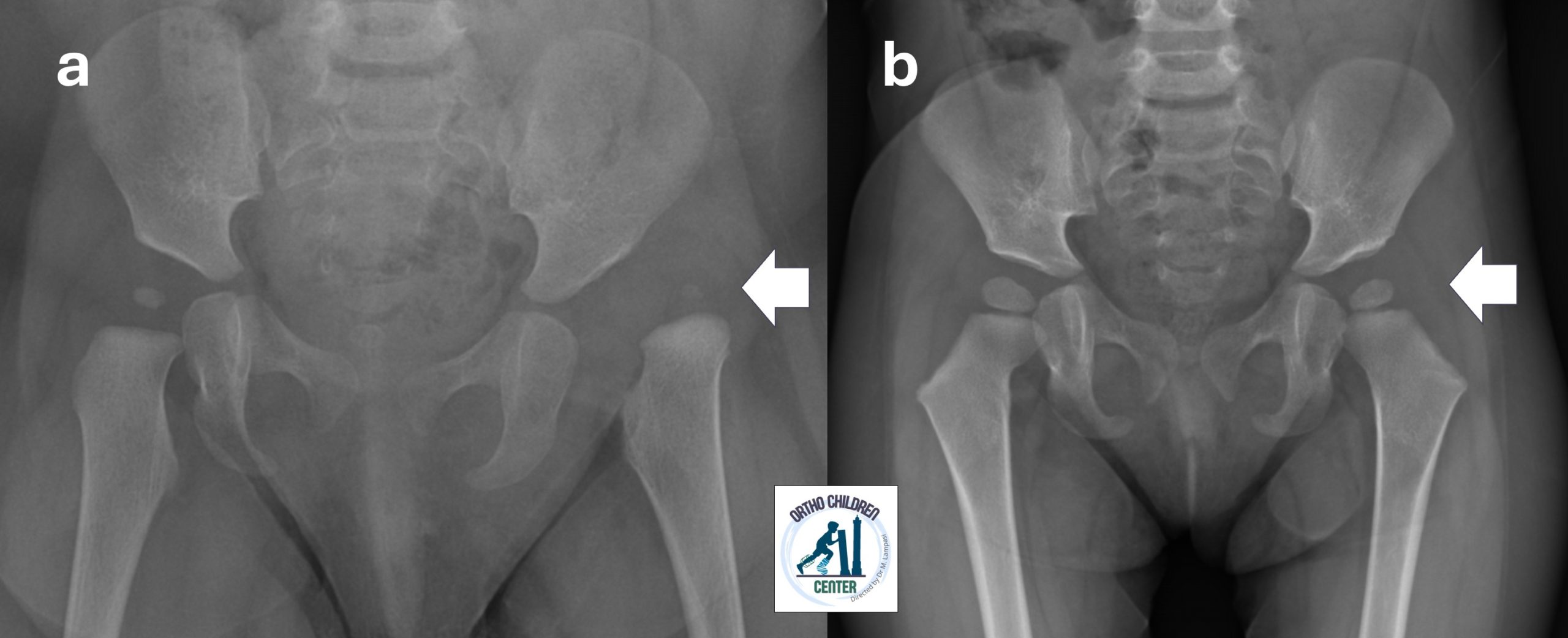 Congenital hip dislocation: late presentation