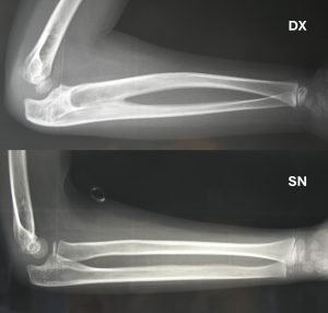 Right radioulnar synostosis (same patient as in previous photos): then he underwent corrective surgery