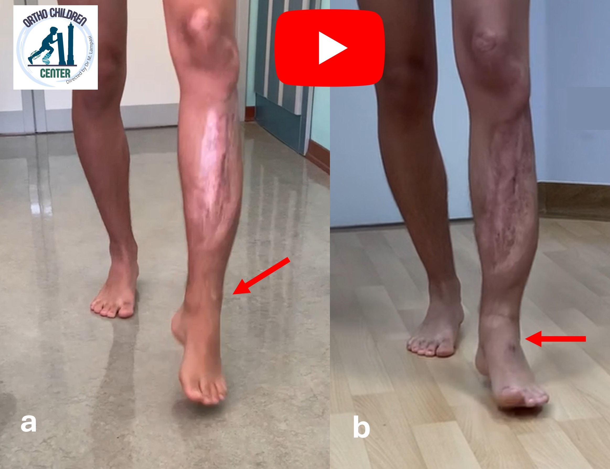 Piede cadente: transfer del tibiale posteriore, 14 anni