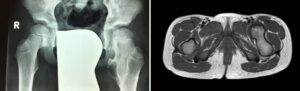 6 years old, exostosis of the proximal femur with nerve compression and pain. Surgery was performed to remove the proximal femur.