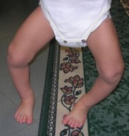 Morbo di Blount infantile bilaterale con grave varismo