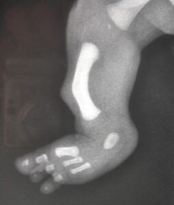 Procurvation of the tibia