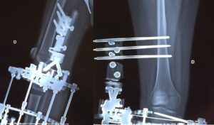 15 years old, fibular hypoplasia with marked knee instability. A knee-bridge brace was applied initially (a, b), later removed.