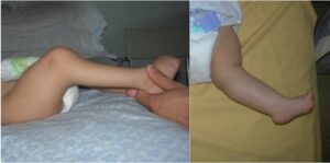 Flexion (a) and extension (b) contracture in arthrogryposis