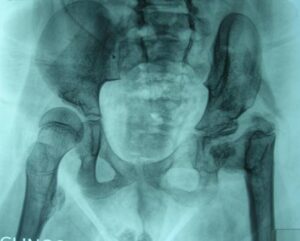 Paziente con mielomeningocele sottoposto a numerosi interventi per la riduzione dell’anca sinistra. Ne è esitata un’articolazione deformata e rigida
