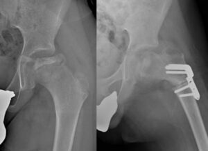 Morbo di Perthes (a) sottoposto ad intervento di osteotomia femorale. Buon risultato di centrazione della testa femorale; incremento del varismo e innalzamento del gran trocantere (b)