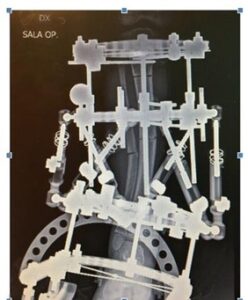 Bifocal lengthening with deformity correction performed with hexapodalic external fixator