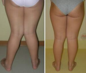 Paziente sottoposta a epifisiodesi mediale del femore distale per ginocchio valgo in ipocondroplasia prima dell’intervento (a) e dopo 2 anni (b)