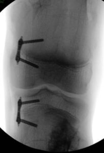 Medial hemiepiphysiodesis for genu valgum in a boy with HME