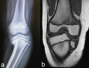 (a) tipico aspetto radiografico. (b) Esempio di risonanza magnetica con evidenti deformazioni articolari