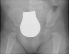 Esempio di protezione per le gonadi eccessivamente ampia, tanto da ostacolare la visualizzazione ottimale dell’anca destra (Kumar 2018)