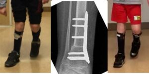 Extrarotazione eccessiva gamba dx (a), sottoposta a osteotomia derotativa tibiale (b) con beneficio nella fase di appoggio (c)