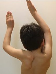 Scapola alta congenita sinistra: marcata limitazione dell’abduzione (rispetto alla destra normale)