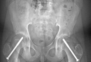 In situ fixation