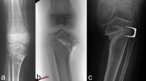 Esempi di trattamenti chirurgici incompleti. Osteotomia di valgizzazione senza correzione dello scivolamento del piatto tibiale (a); osteotomia di sollevamento del piatto ma senza correzione del varismo (b); osteotomia di sollevamento del piatto e epifisiodesi laterale, ma con persistenza di varismo marcato (c)