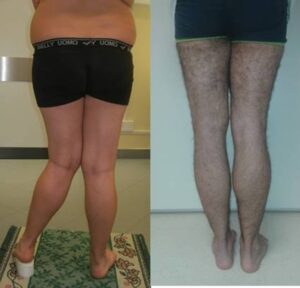 Paziente con ginocchio valgo sinistro e arto più corto. E’ stata eseguita correzione con allungamento dell’arto mediante fissatore esterno