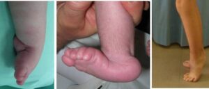 Different foot involvements in arthrogryposis: a) talipes equinovarus adductus; b) vertical talus; c) equinus foot