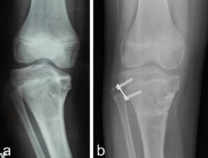 Doppia osteotomia (di sollevamento del piatto tibiale e correzione del varismo) e epifisiodesi laterale con placca a 8. Aspetto rx pre- e postoperatorio