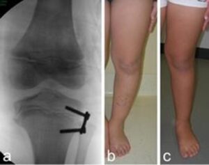 Paziente sottoposto a epifisiodesi laterale di tibia prossimale per morbo di Blount in fase iniziale. Aspetto radiografico dopo l’intervento (a), aspetto clinico prima dell’intervento (b) e a correzione ottenuta (c)