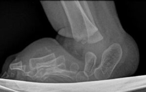 A vertical talus was treated elsewhere with several months of corrective casts. Correction was not achieved.