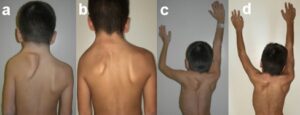 Scapola alta congenita sinistra operata: aspetto clinico pre- (a) e post-operatorio (b); miglioramento del deficit di abduzione della spalla, aspetto pre- (c) e post-operatorio (d)