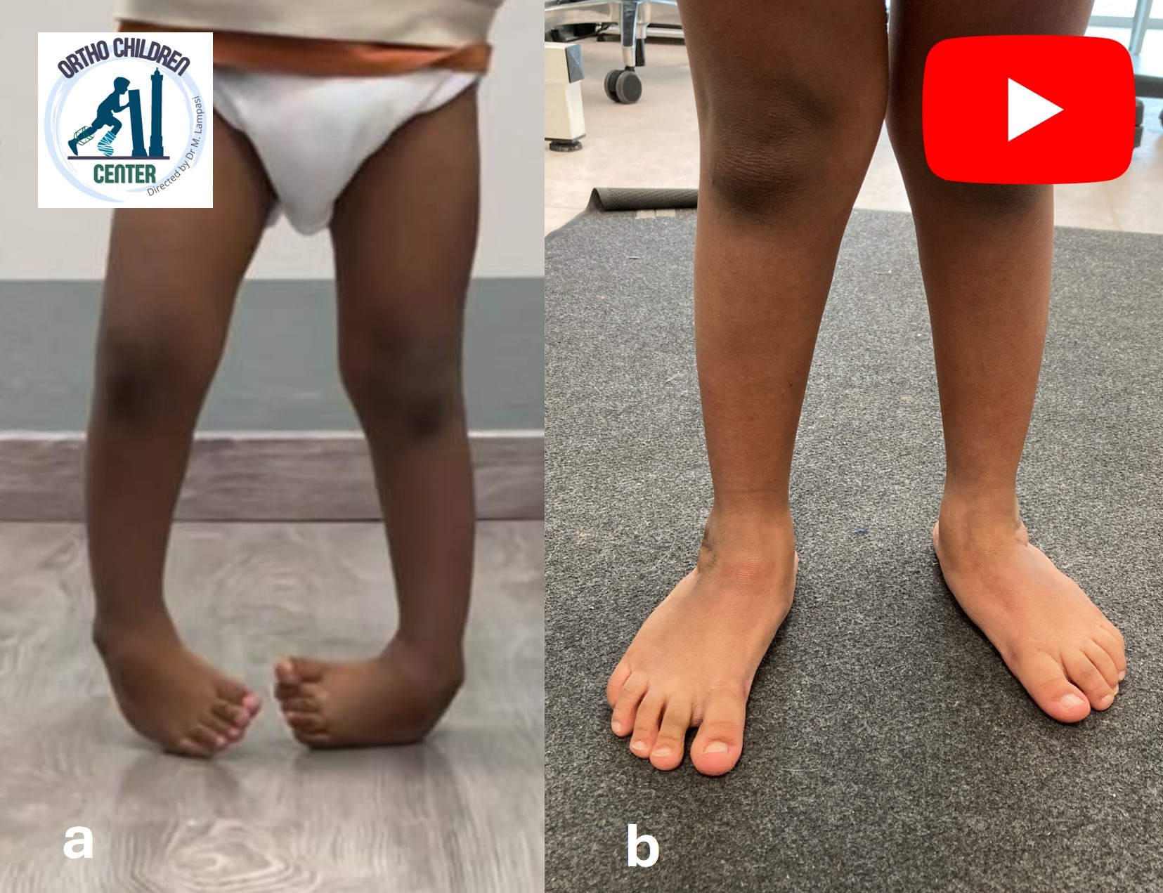 Piede torto (recidiva): intervento mini-invasivo