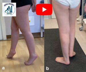 Cammino sulle punte: intervento mini-invasivo