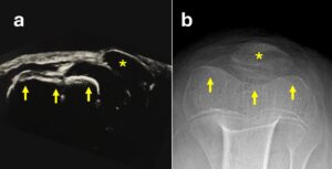 Lussazione congenita di rotula