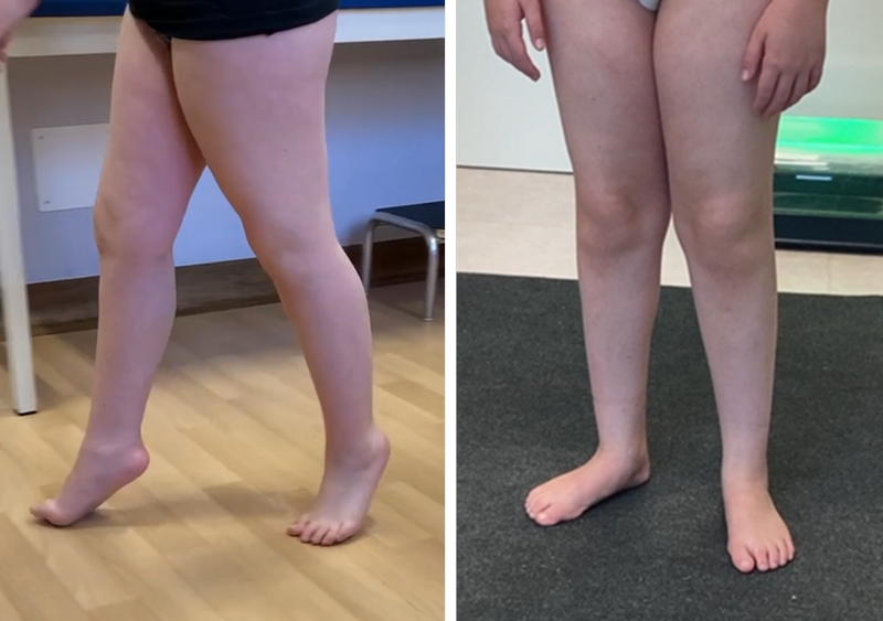 Paziente affetto da autismo: quadro clinico prima e 3 anni dopo l’intervento 