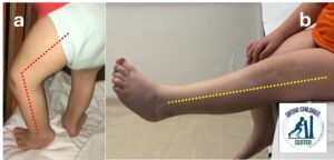 Lussazione congenita di rotula: risultati del trattamento