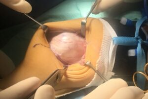 Lussazione congenita di rotula: trattamento