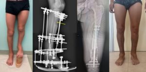 Severe shortening of the left lower limb (up=12 cm) with severe deformity of the ankle and foot. Deformity correction and leg lengthening with external fixator. Subsequent femoral lengthening with intramedullary magnetic nail. Excellent final result
