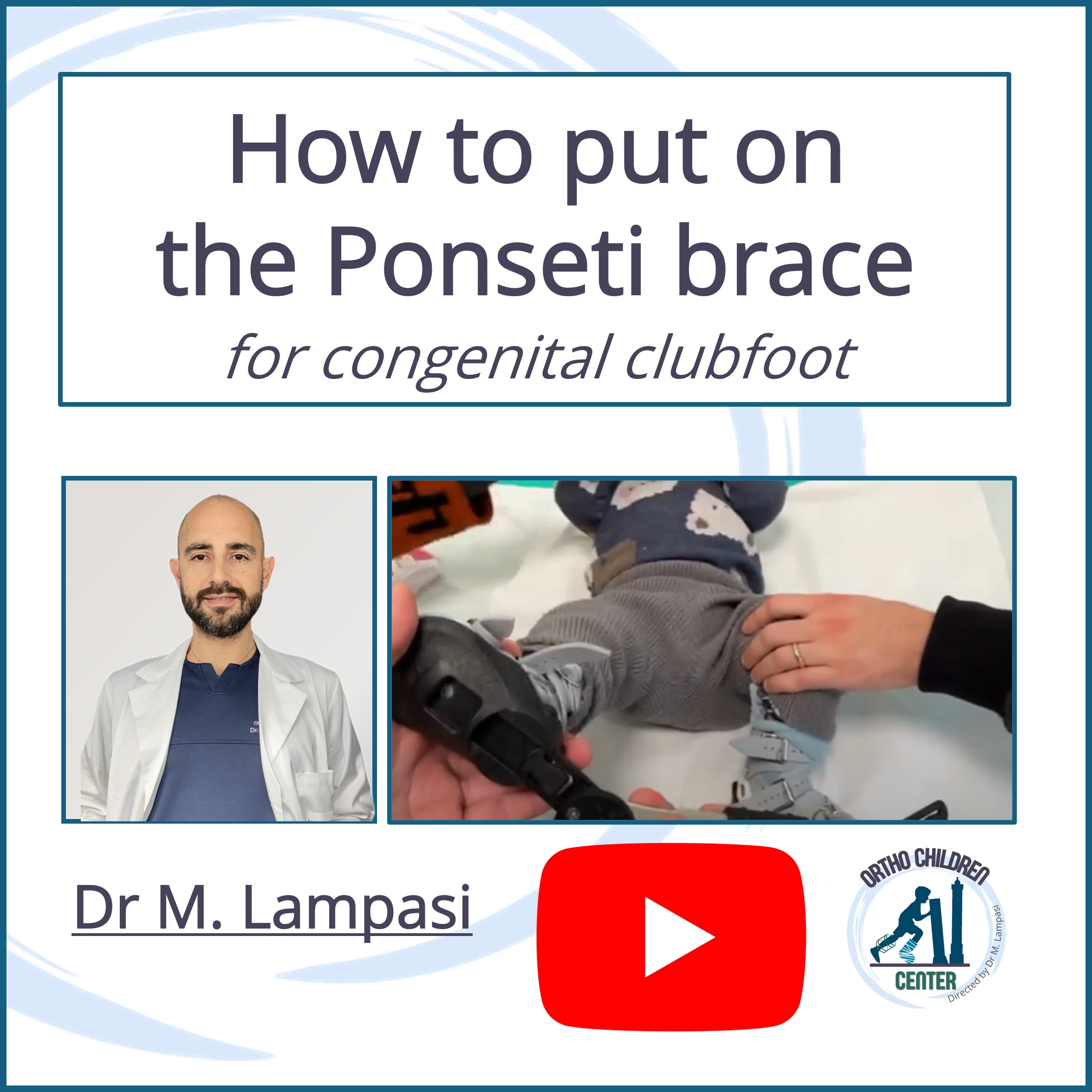New tutorial: How to put on the Ponseti brace for congenital clubfoot (Dr. Lampasi, Ponseti International)