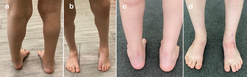 Piede torto sinistro già sottoposto all’estero a intervento di transfer senza successo (a,b). Risultato dopo complesso intervento di revisione (c,d)