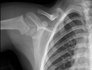 Pseudartrosi congenita di clavicola