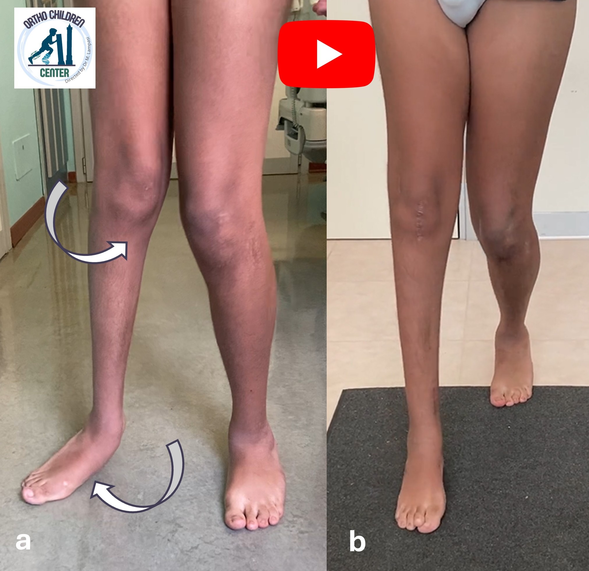 Intervento correttivo Multilevel in emiparesi destra (Paralisi Cerebrale Infantile)