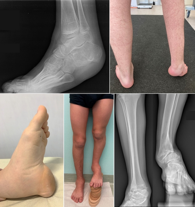 Esempi di deformità complesse di piede e caviglia trattate nel nostro Centro