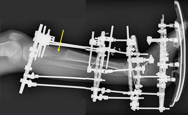 Paziente in trattamento per grave deformità di caviglia/piede e marcata ipometria dell’arto inferiore sinistro. Correzione della deformità ed allungamento della gamba con fissatore esterno (la freccia gialla indica la zona dove la gamba è stata allungata di 6 cm)